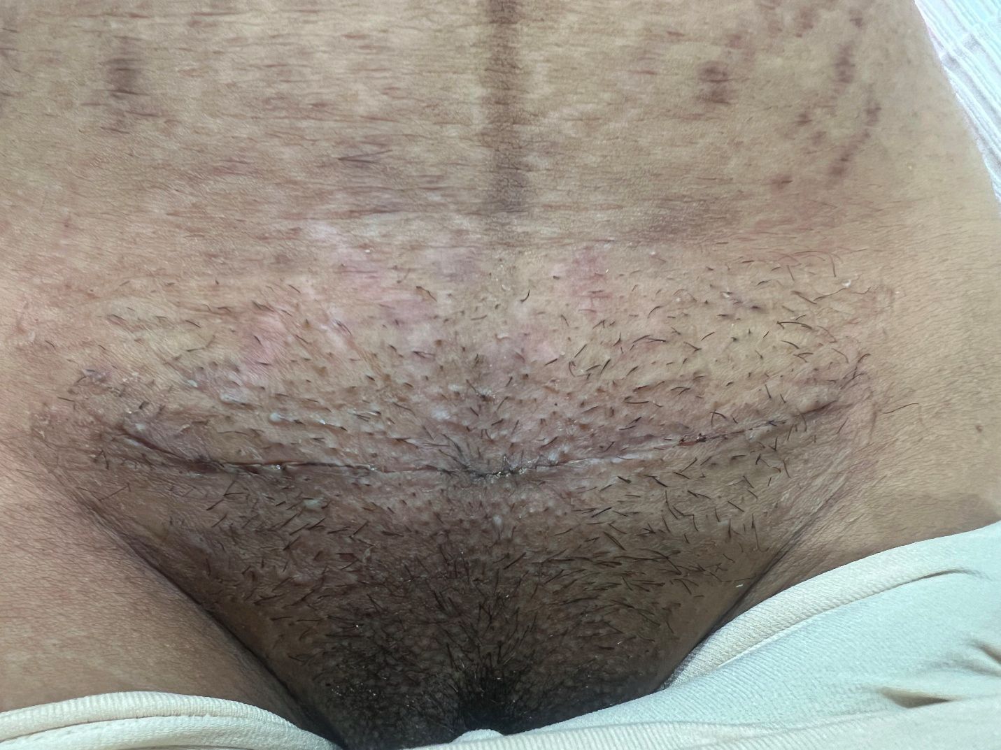 Labioplastia - Caso 8
