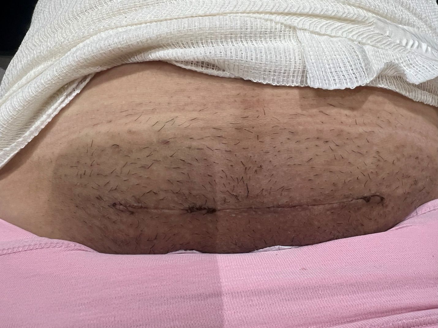 Labioplastia - Caso 8