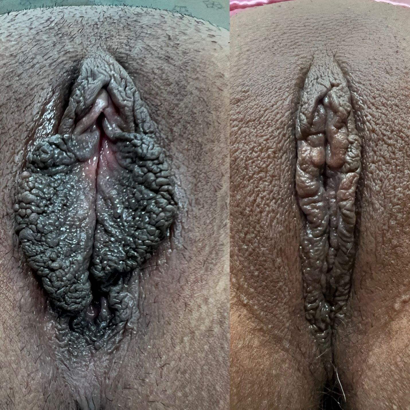 Labioplastia - Caso 8